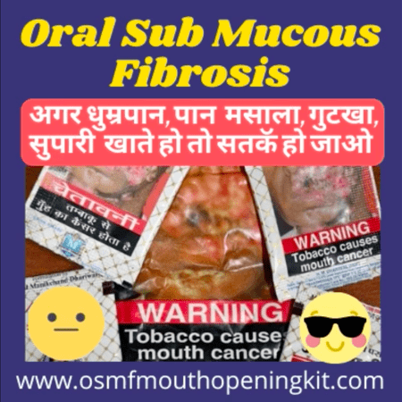 oral submucous fibrosis staging