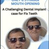 Mouth Opening OLI Therapy and Fixed Teeth by Dental Implants Review
