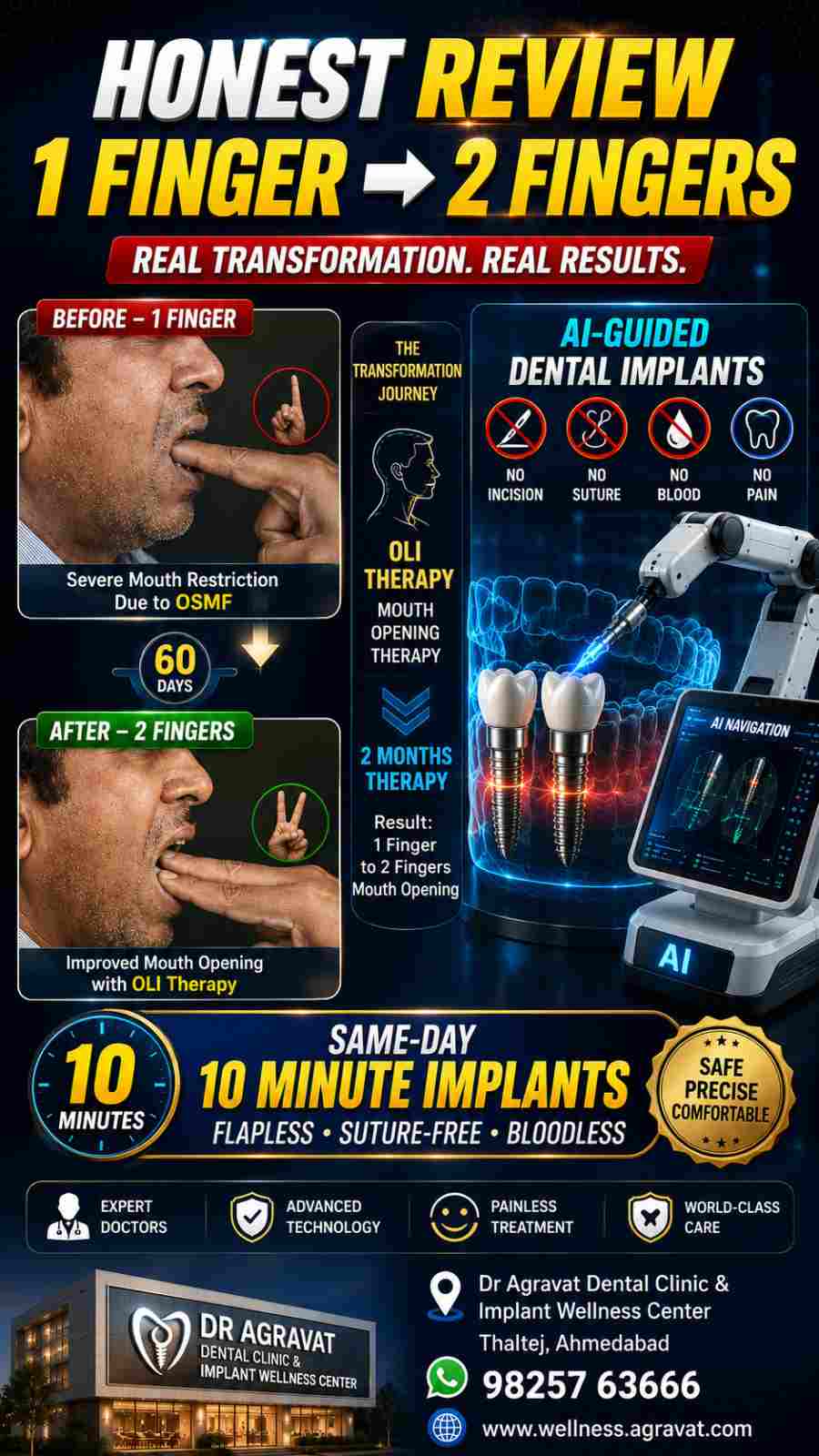 Honest Review 1 FINGER 2 FINGERS OSMF Mouth Opening Program OLI Therapy Same day Dental Implant Ahmedabad Gujarat India